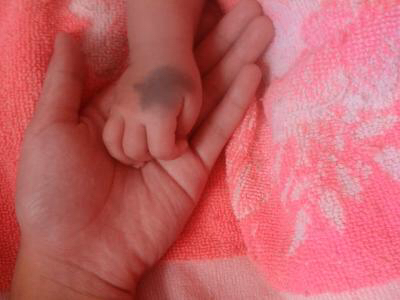 新生儿特殊生理现象照片,新生儿的正常生理现象