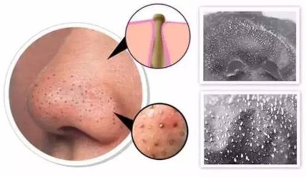 黑头既恐怖又恶心，教你四招打败黑头君