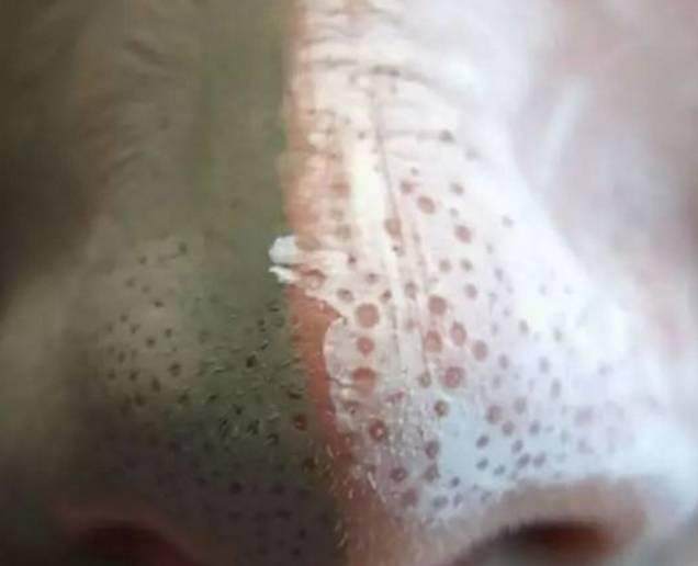 鼻子上挤出来的白色条状怎么治疗,鼻子上挤出来的黄米粒怎么办