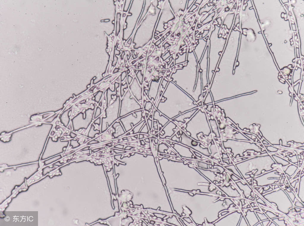 生殖器念珠菌病的临床症状是什么,生殖器念珠菌有什么症状