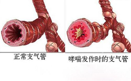 支气管哮喘诊断金标准,儿童支气管哮喘诊断与防治指南