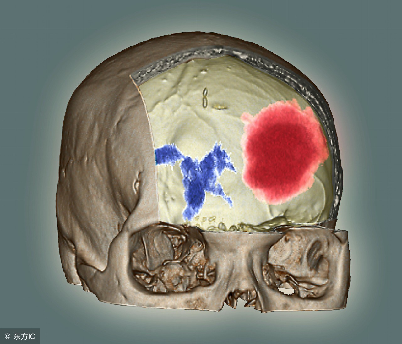 脑溢血后遗症的康复锻炼方法,脑溢血后遗症能不能康复