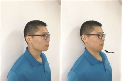 青少年驼背怎么办?这些动作应该练