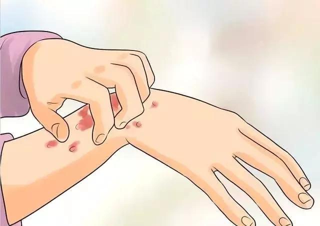 荨麻疹适合哪种益生菌,荨麻疹吃药控制住了突然又加重