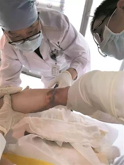 三度烧烫伤的症状是什么,儿童烫伤反复发冷发烧怎么办