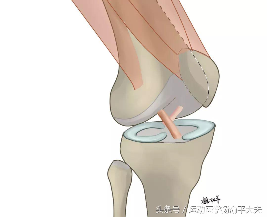 半月板撕裂保守治疗哪个膏药好,半月板后角撕裂的最好治疗方法