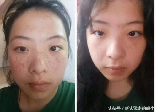 孕妇脸上长斑吃什么,孕妈脸上有斑怎么办