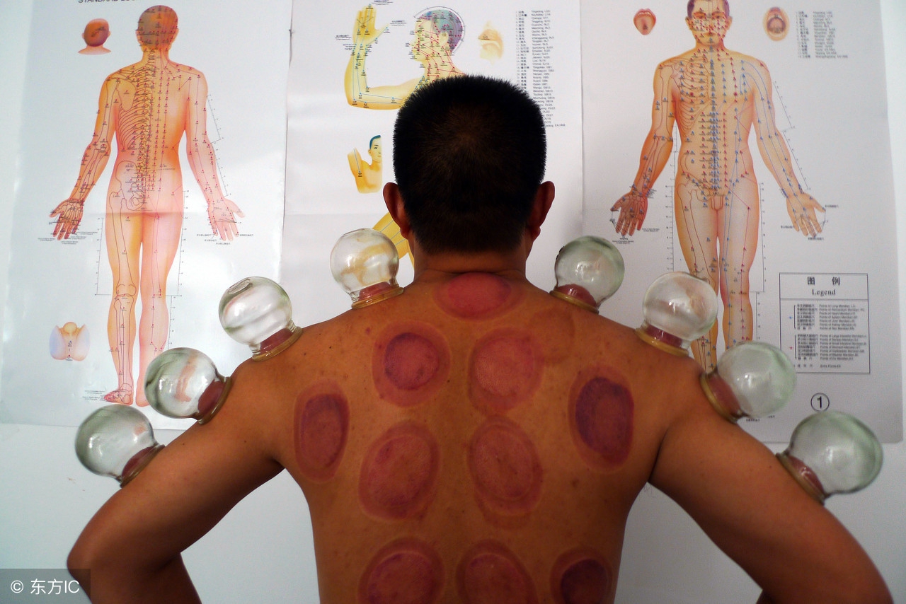 拔火罐印记颜色代表什么,拔火罐黑紫印是什么原理