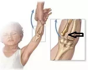 双排牙预防方法,预防孩子双排牙有什么方法