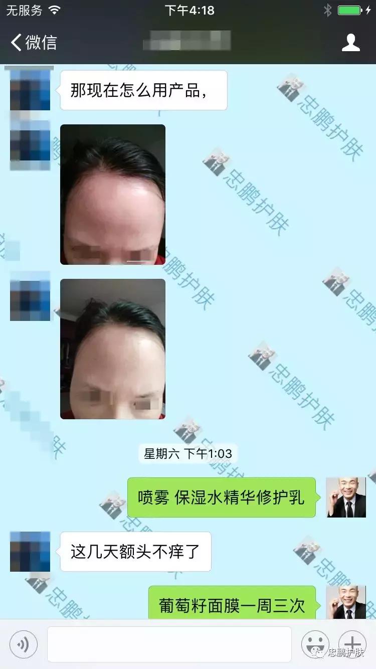 激素脸发红发热脱皮怎么办呢,激素脸为什么会扩散到脖子上代谢