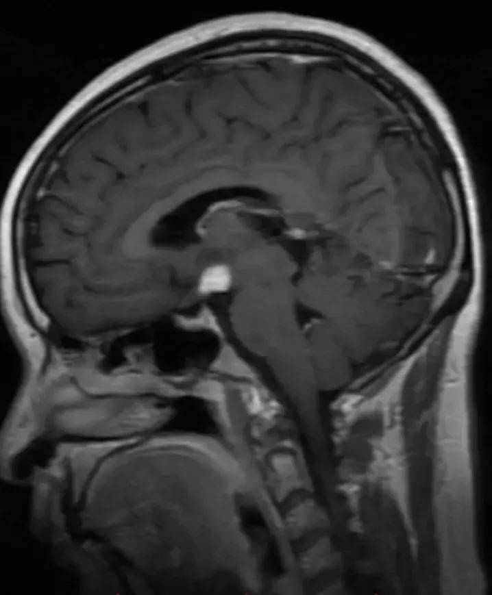 复旦大学附属中山医院放射科病例讨论（八十四）