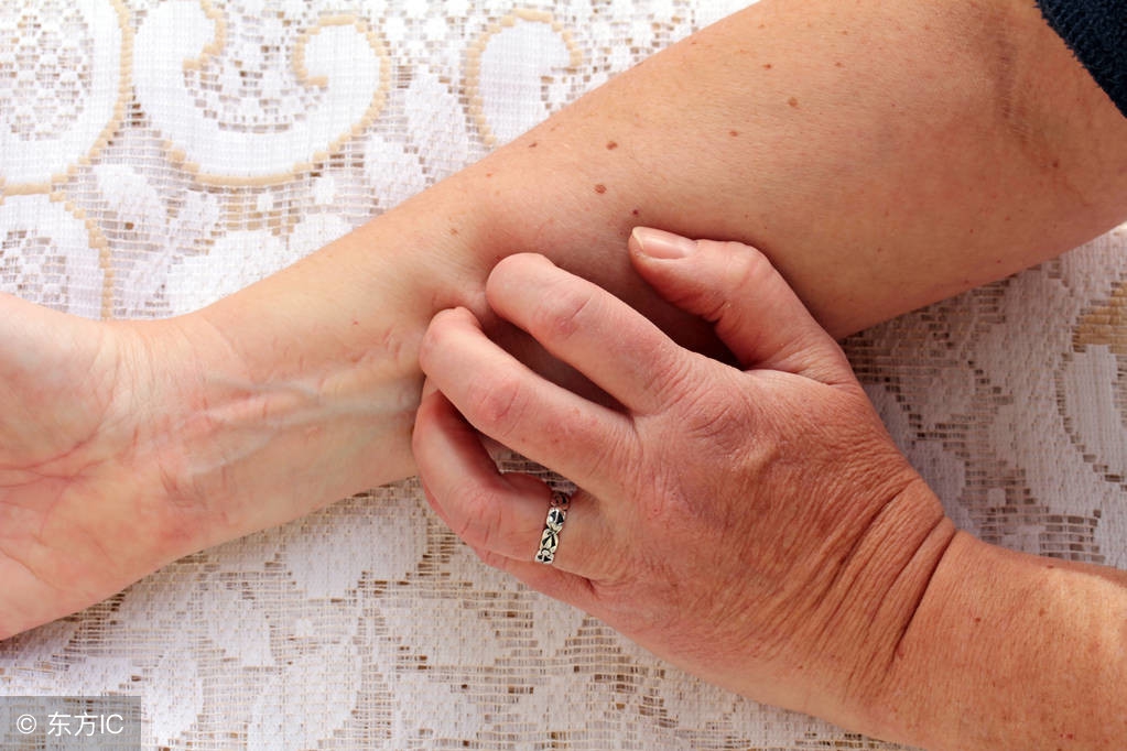 神经性皮炎在饮食上注意什么,得了神经性皮炎吃什么口服药