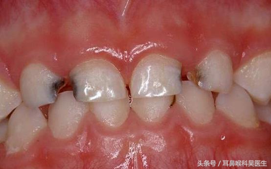 龋齿原因及防治方法,小儿龋齿的原因及防治措施