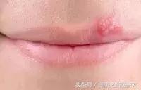 长在嘴边上的痘痘什么原因,嘴边长痘痘然后嘴肿了