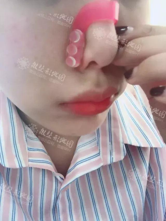 整形“神器”大测评：传说中的隆鼻夹真的靠谱吗？