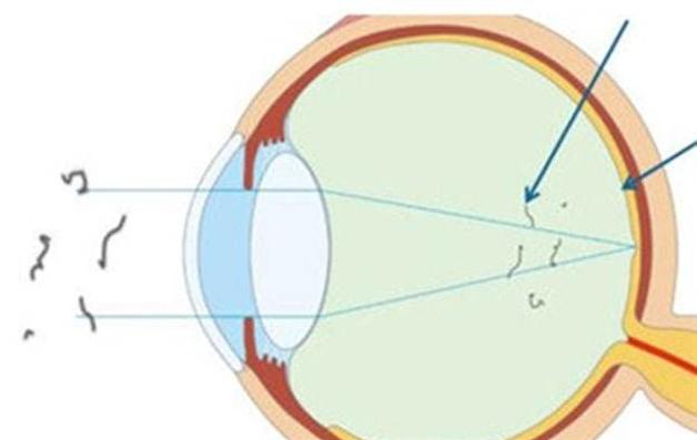 眼科飞蚊症的治疗方法,中医眼科飞蚊症的治疗