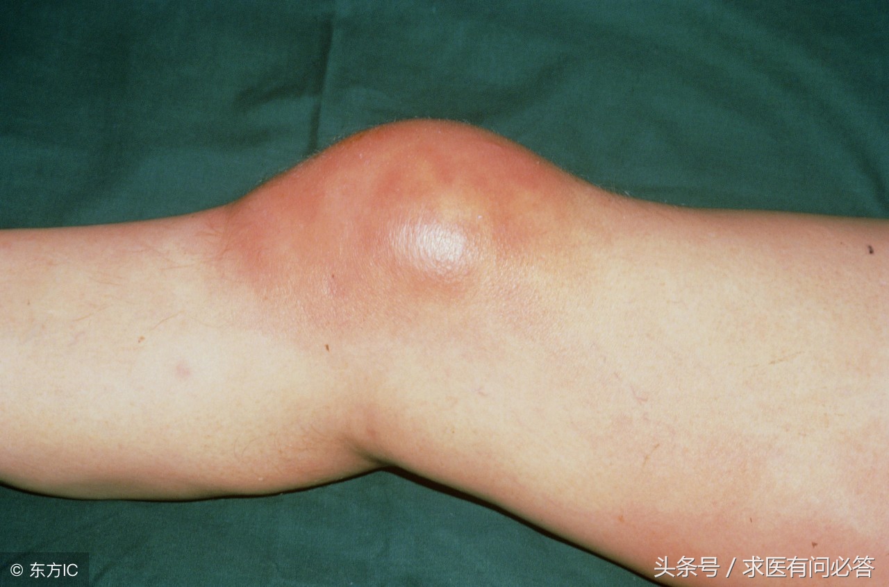 绒毛结节性滑膜炎饮食注意事项,痛风和滑膜炎饮食上应注意什么