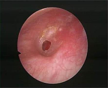 刘女士最近的消息,女子耳朵发闷听力下降