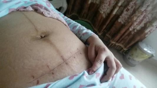 剖腹产其实也很疼，护士压产妇肚子，生孩子太不容易了