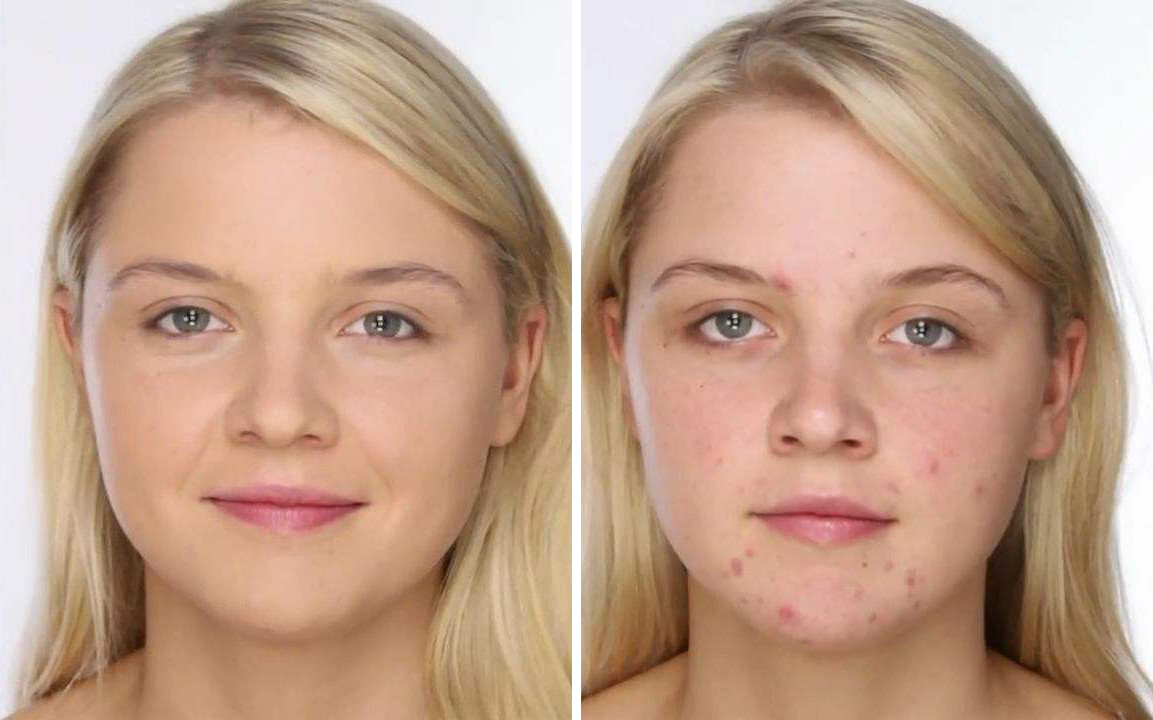 头发出油掉发后背长痘,前胸后背下巴长痘怎么回事