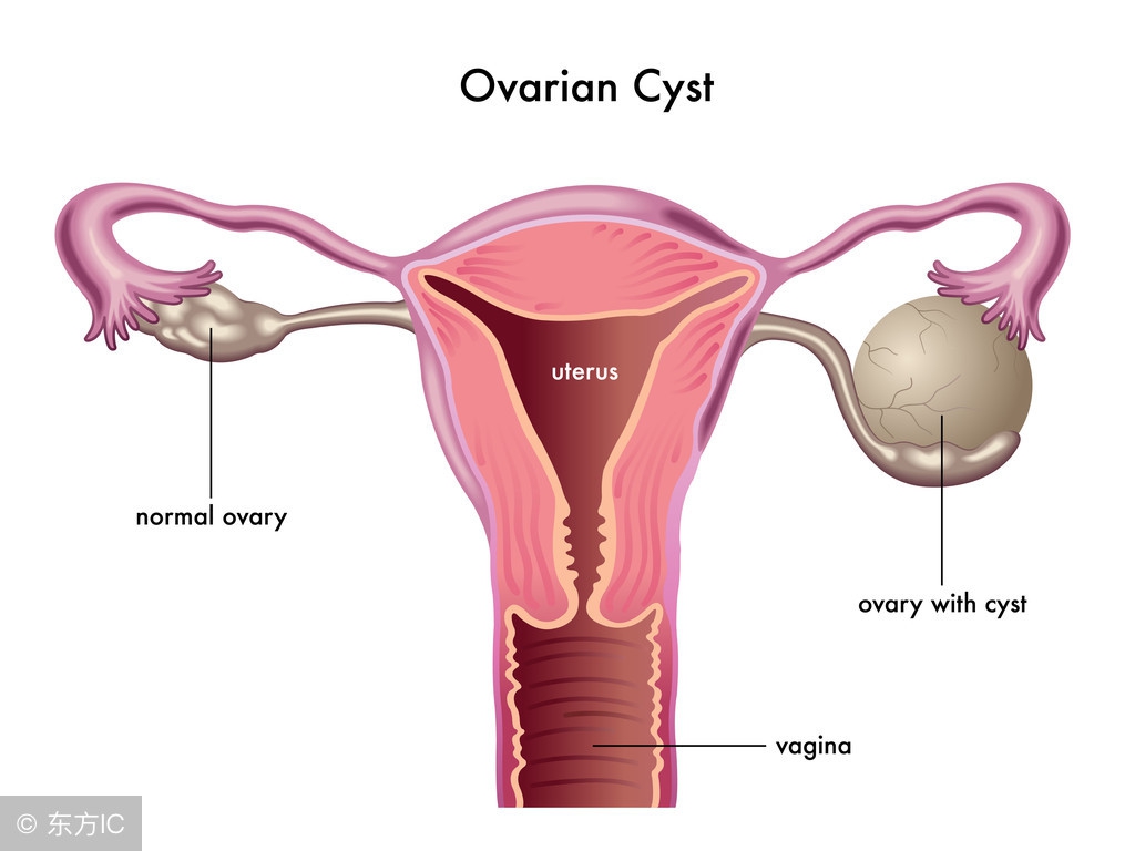 卵巢囊肿最常见病因,卵巢囊肿形成的原因及治法