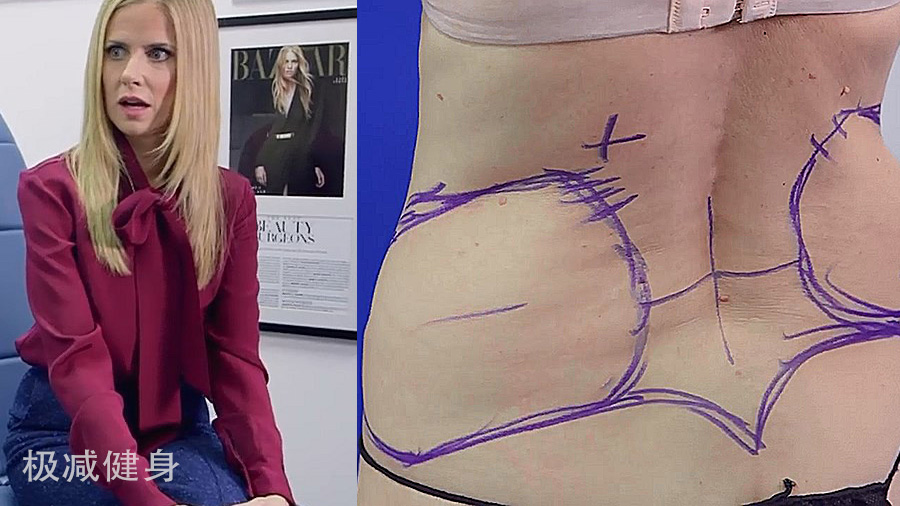 抽脂减肥的过程与效果,抽脂减肥的过程和效果