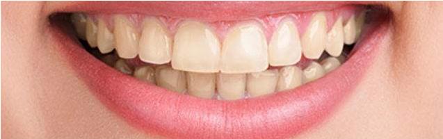 牙齿呈现什么颜色时最健康,牙齿为什么会有斑点