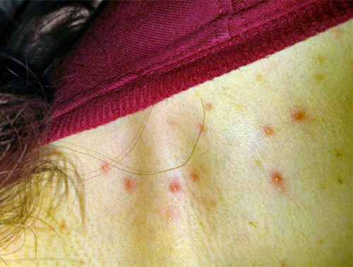 前胸后背长痘痘是什么原因引起的,前胸后背脖子长痘痘是什么原因呢