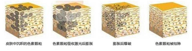 褐斑有几种,褐青色斑什么原因