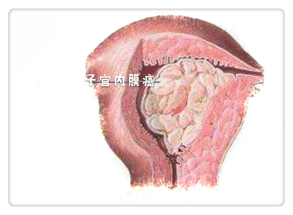 左小腹疼痛阴道流血是什么症状,下腹隐痛要警惕四种病白带多