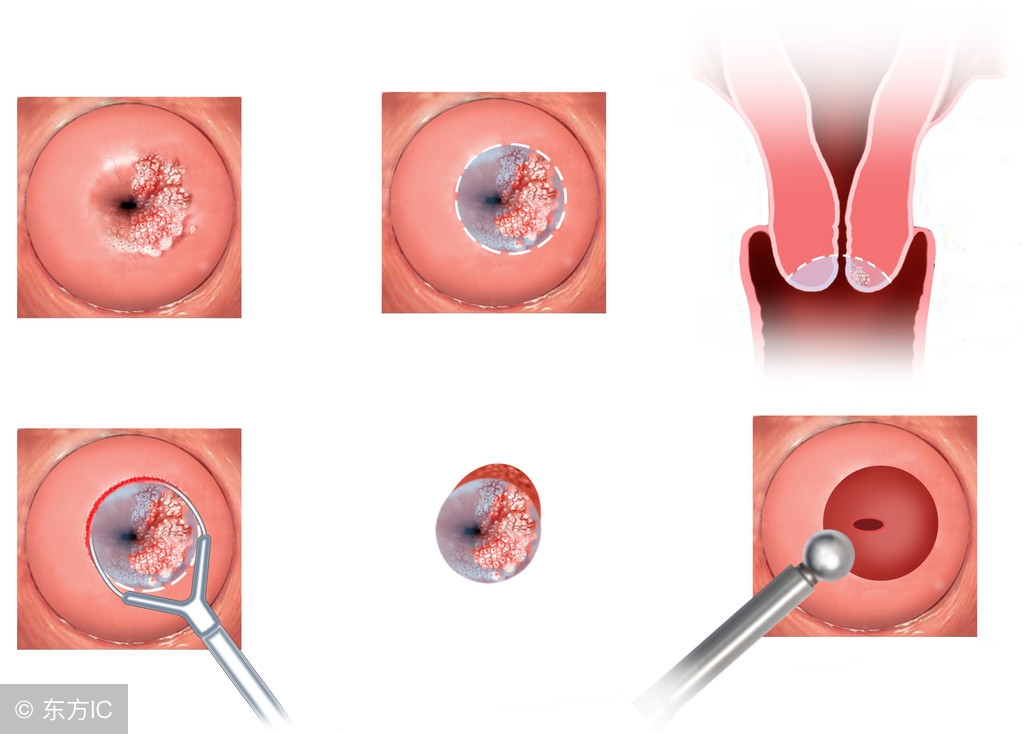 宫颈癌的医学诊断依据