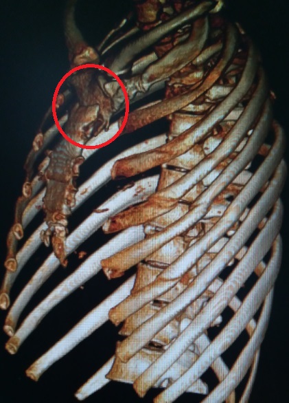 胸廓塌陷畸形自我矫正,胸廓畸形的标准是什么