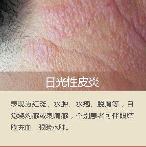 面部脂溢性皮炎辨别图片,面部脂溢性皮炎怎么治