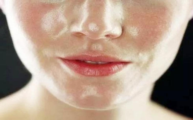 脸上瘙痒起皮屑怎么处理,脸上发痒有螨虫咋治