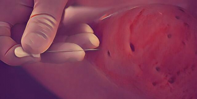 专治顽固性颈椎病针刀,可视针刀镜能治颈椎病