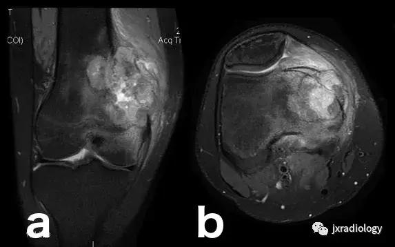 膝关节骨髓水肿疼痛特点,膝关节骨髓水肿的临床表现