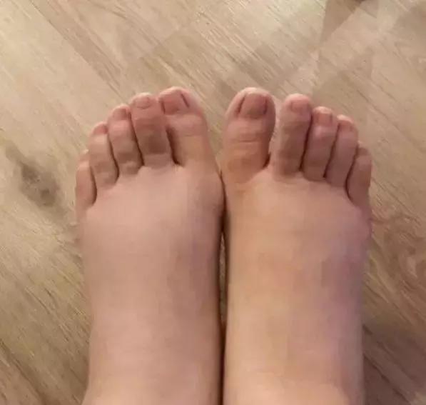 高龄产妇产后腿肿脚肿怎么回事,女明星产后迅速恢复的秘诀