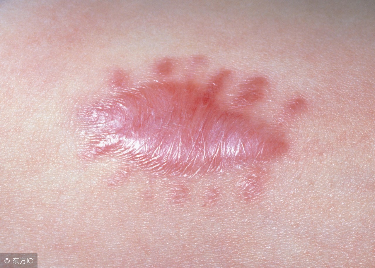 疤痕贴的主要成分,各种疤痕膏祛疤效果