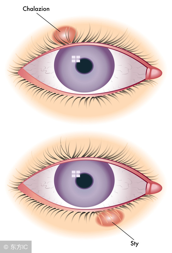 麦粒肿肉芽上打一针的作用,治疗麦粒肿的特效穴