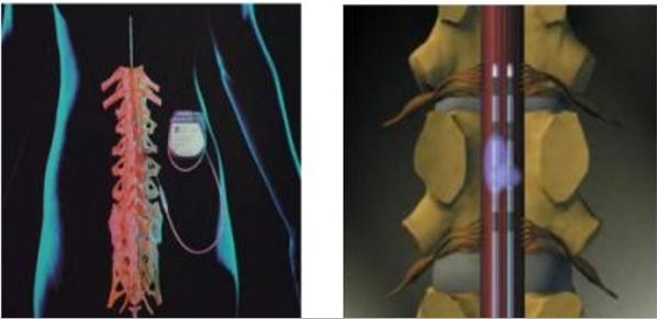带状疱疹导致右侧胸口疼痛怎么办,得带状疱疹十几年了胸口疼