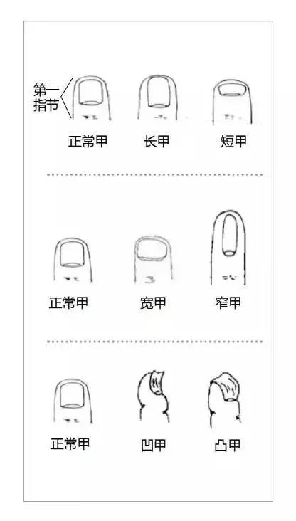 警惕指甲出现它是大病前兆,关于指甲变化异常的疾病