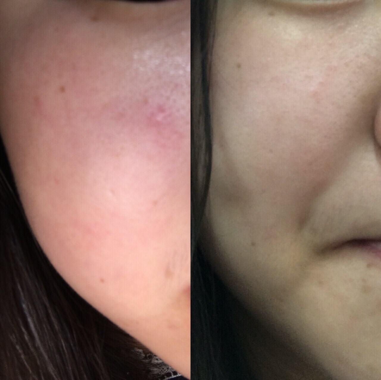 消炎修复祛痘面霜,祛痘清凉霜推荐哪个