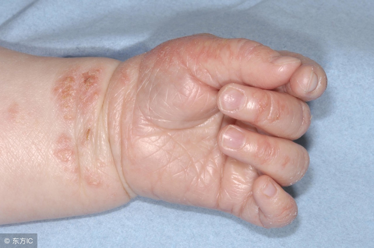 因湿疹而引起的皮肤瘙痒如何处理,湿疹反复发作奇痒中医给两种方法