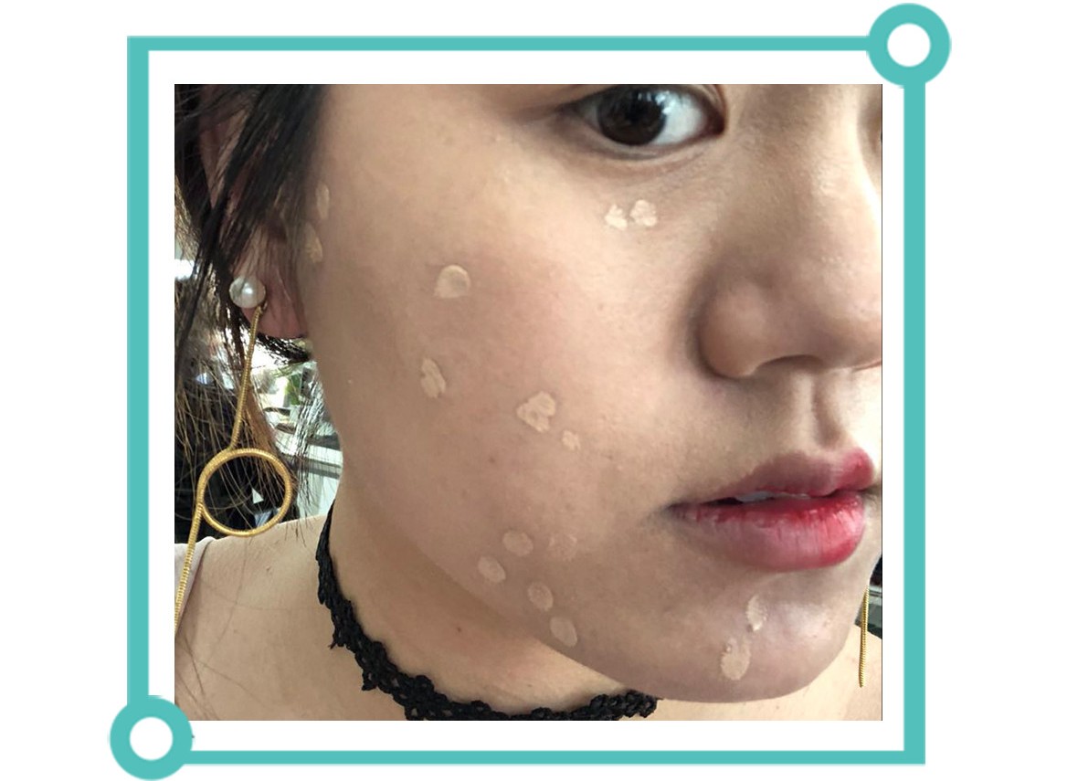 青少年痘印怎么消除小妙招,如何消除痘印祛痘