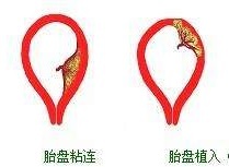 疤痕子宫可以生三胎剖宫产吗,一次剖宫产永远剖宫产吗