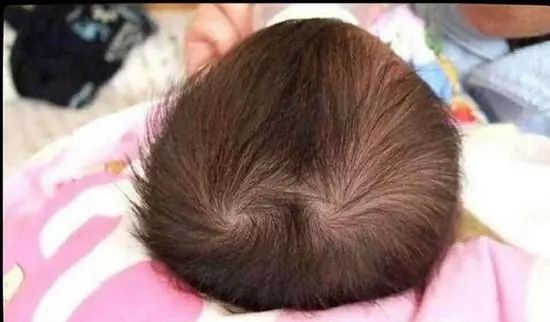 为什么头顶上有发旋,脑袋上有旋是怎么回事