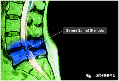 左腰背部疼痛是什么原因引起的,湿气重会腰背部疼痛吗