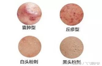 各种痘痘的类型及治疗方法,四种常见的痘痘类型应该如何区分