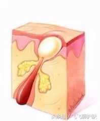 各种痘痘的类型及治疗方法,四种常见的痘痘类型应该如何区分