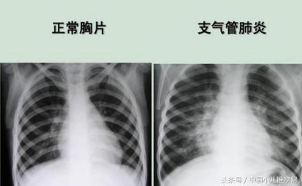 小儿脾虚弱,小儿推拿脾虚弱胃动力差